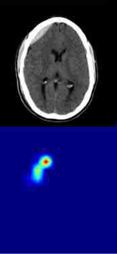 Bild, welches einen CT-Scan zeigt von einem Kopf und daneben einen farblich markierten Bereich, wo die KI eine Hirnblutung sieht.